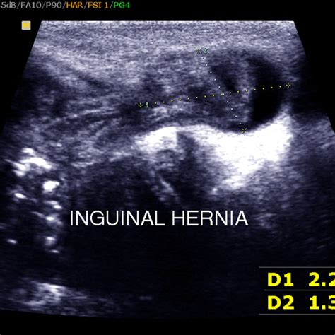 usg para avaliar hernia inguinal