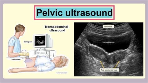 USG Pelvis Sonography: Accurate Diagnosis for Women's Health