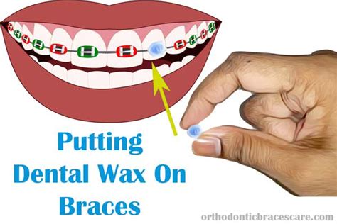 Using Dental Wax