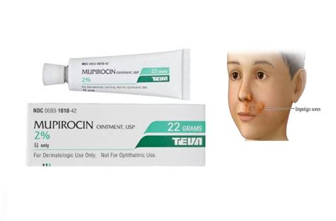 using mupirocin topical in nose