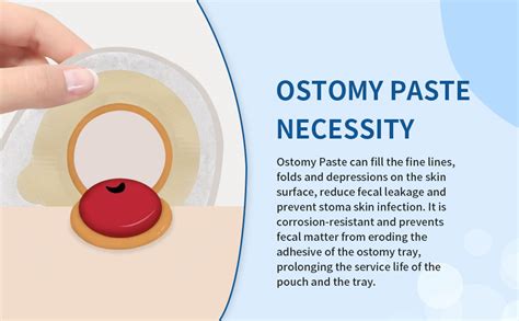 Using Ostomy Paste