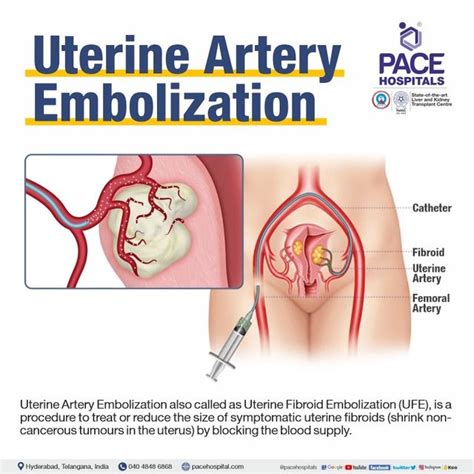 Uterine Artery Embolization: A Minimally Invasive Solution for Fibroid Relief