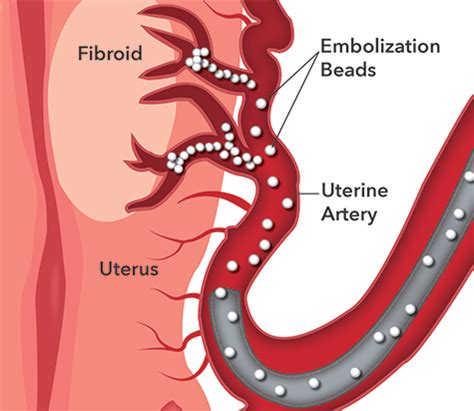 Uterine Fibroid Embolization: Minimally Invasive Relief for Women