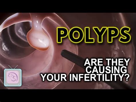 uterine polyp removal cpt code