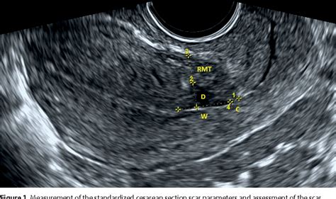 uterine scarring from c section