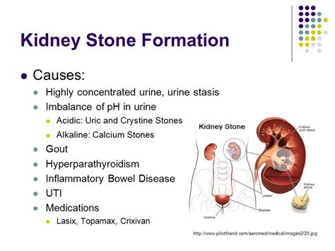 UTI vs Kidney Stone: Key Differences Uncovered!
