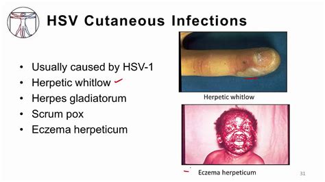 utis with hsv 2 infection