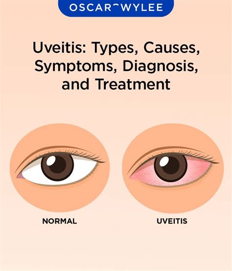 uveitis come and go