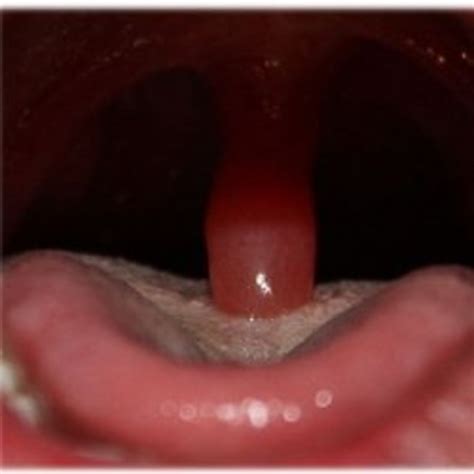 What Happens When Your Uvula Touching Tongue Becomes a Persistent Problem?