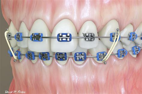 V Elastics Braces