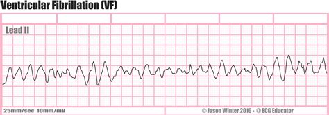 Understanding V Fib EKG: Recognizing and Responding to Ventricular Fibrillation on Electrocardiogram Readings