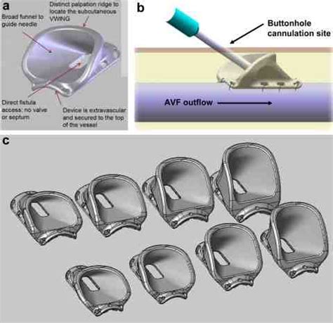 V Wing Dialysis Access