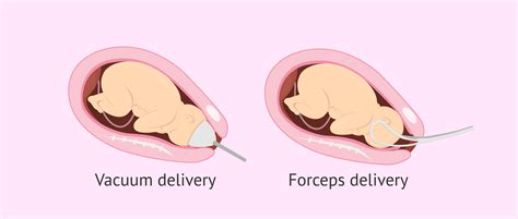 Vacuum Delivery Without Episiotomy