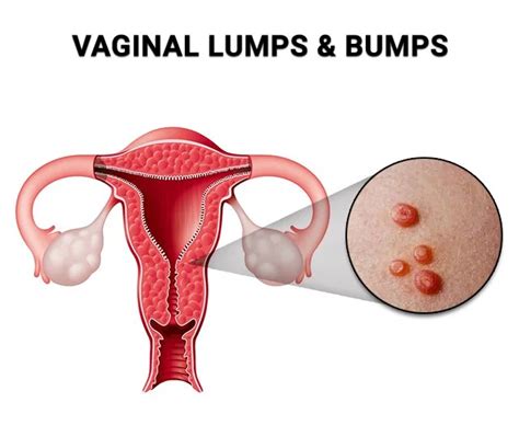 Understanding and Addressing Vaginal White Bumps Causes and Symptoms
