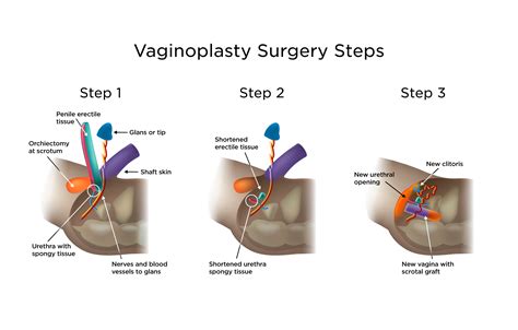 vaginoplasty