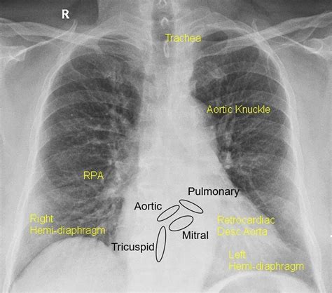 Valve Replacement Cxr
