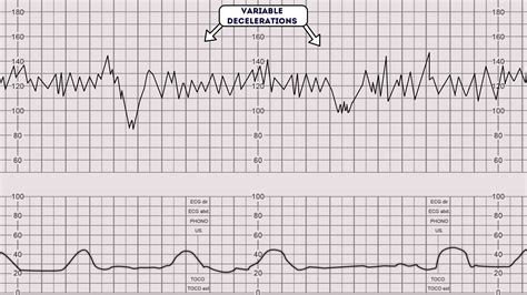 variable deceleration in ctg seen in
