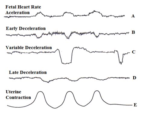 variable vs late decelerations