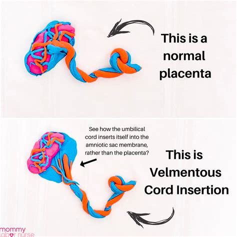 vasa previa vs velamentous cord insertion
