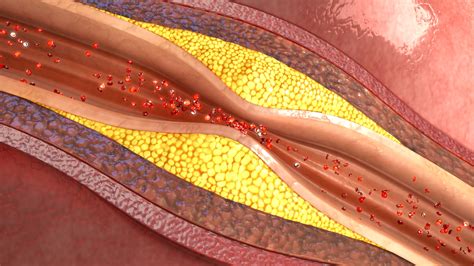 Vascular Bed Atherosclerosis
