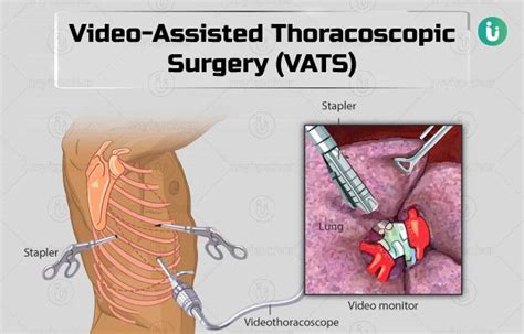 The Role of Vats in Surgery: Minimally Invasive Techniques