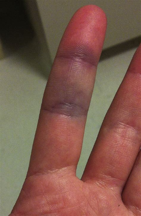 vein rupture in finger