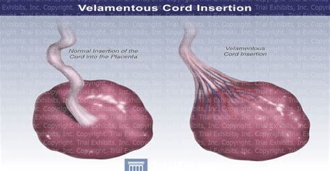 velamentous cord insertion images