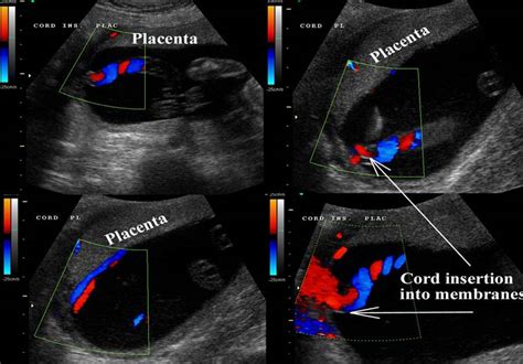 velamentous umbilical cord ultrasound