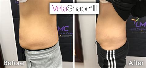 velashape before and after stomach