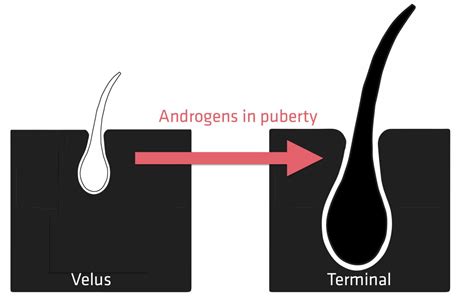 Vellus Hair Electrolysis Reddit