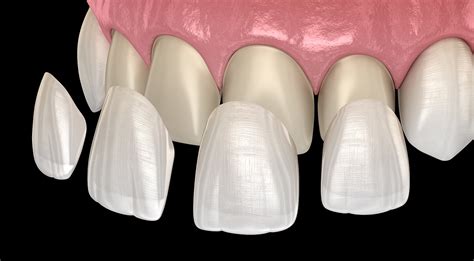 Veneer Crown Define