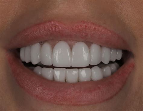 Veneer Replacement Cost Uk