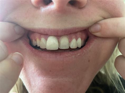 Veneer Teeth Falling Off