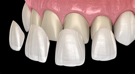 veneer tooth with chip