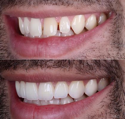 Veneers Cost Uae