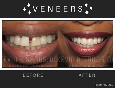 Veneers For Gap Teeth