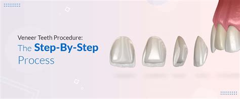 Veneers For Teeth Procedure