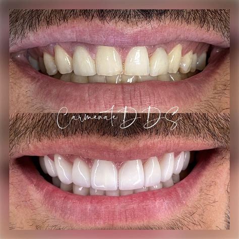 Veneers Miami