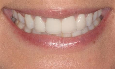 Veneers On Four Front Teeth