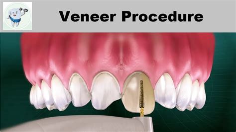 Veneers Procedure Code