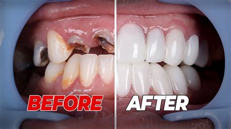 Veneers Rotten Teeth