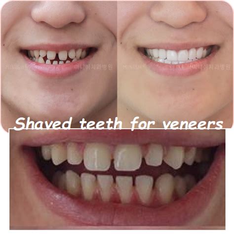 Veneers Teeth Shaven