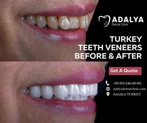 Veneers Teeth Turkey