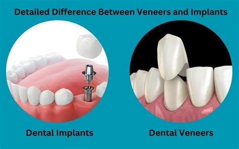 Veneers With Dental Implants