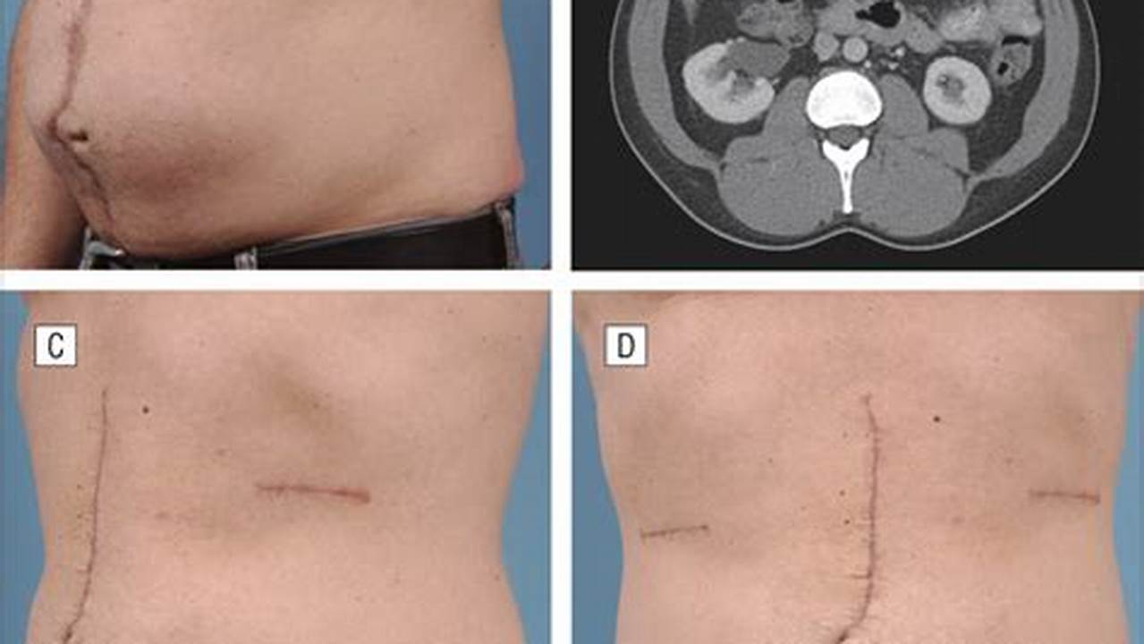 Unveil the Secrets of Ventral Hernia Repair: Before and After Insights