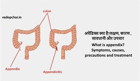 Homeopathic Remedies for Appendicitis — Homeopathic