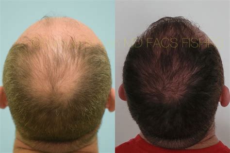 vertex hair loss