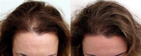 vertex hair loss in women