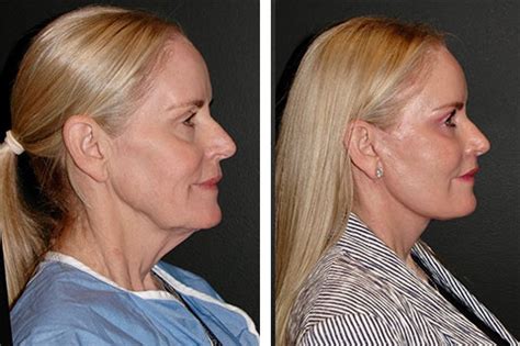 Vertical Facelift Nyc