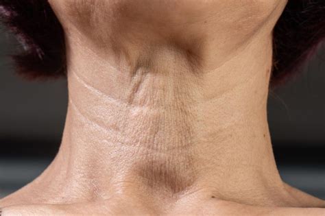 Vertical Lines On Neck Surgery